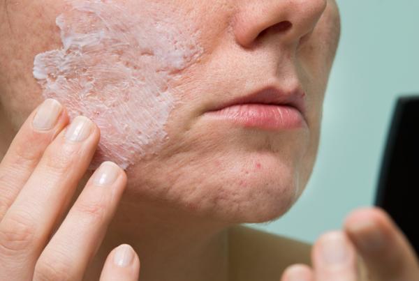 Best Treatment for Acne Scars