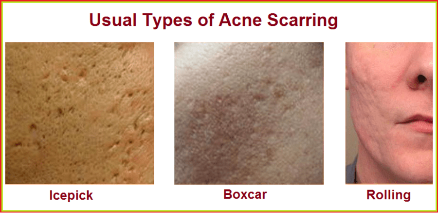 Different Types of Acne Scars
