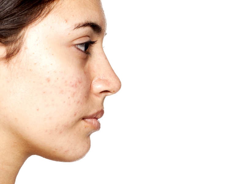 Acne Treatment Murfreesboro TN - Acne Scars Best Treatment