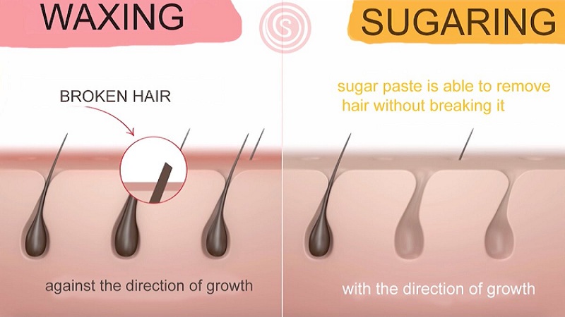 Sugaring vs. Waxing Ingrown Hairs