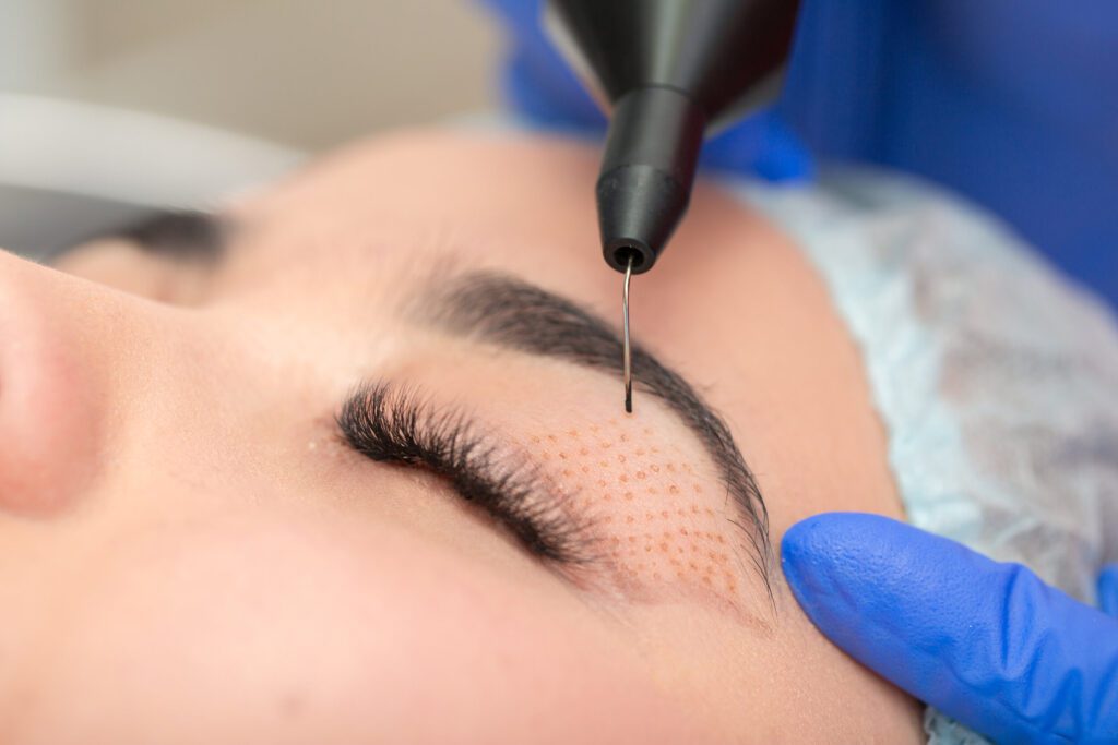 Plasma Fibroblast Skin Lifting Procedure