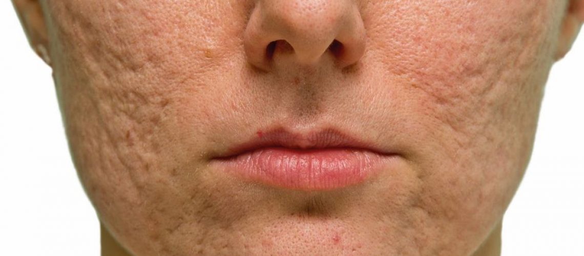 Get Rid of Old Acne Scars